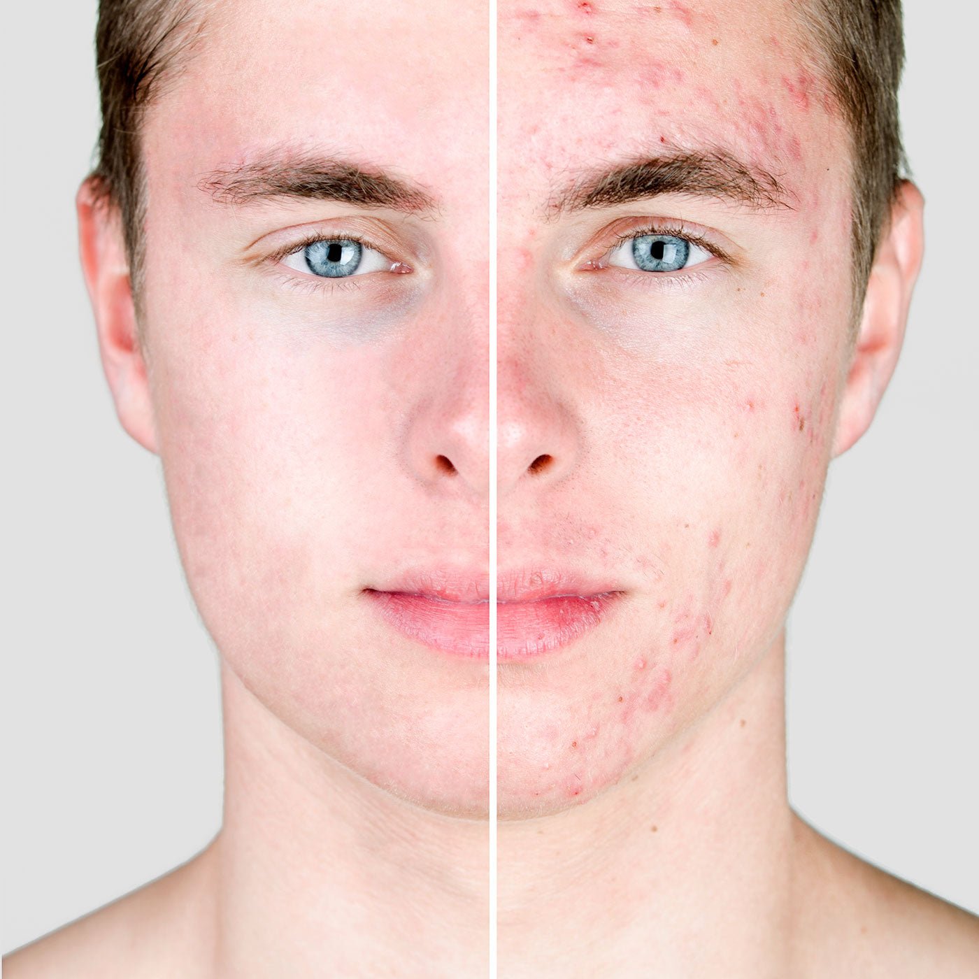 Acne - Myers Dermatology & Clinical Spa