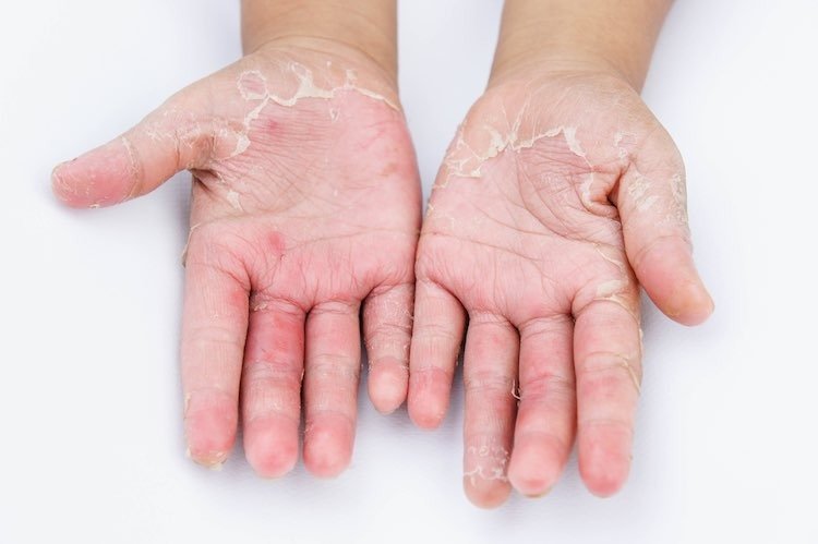 Allergic Contact Dermatitis - Myers Dermatology & Clinical Spa