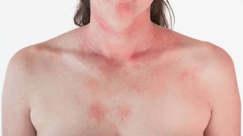 Eczema - Myers Dermatology & Clinical Spa