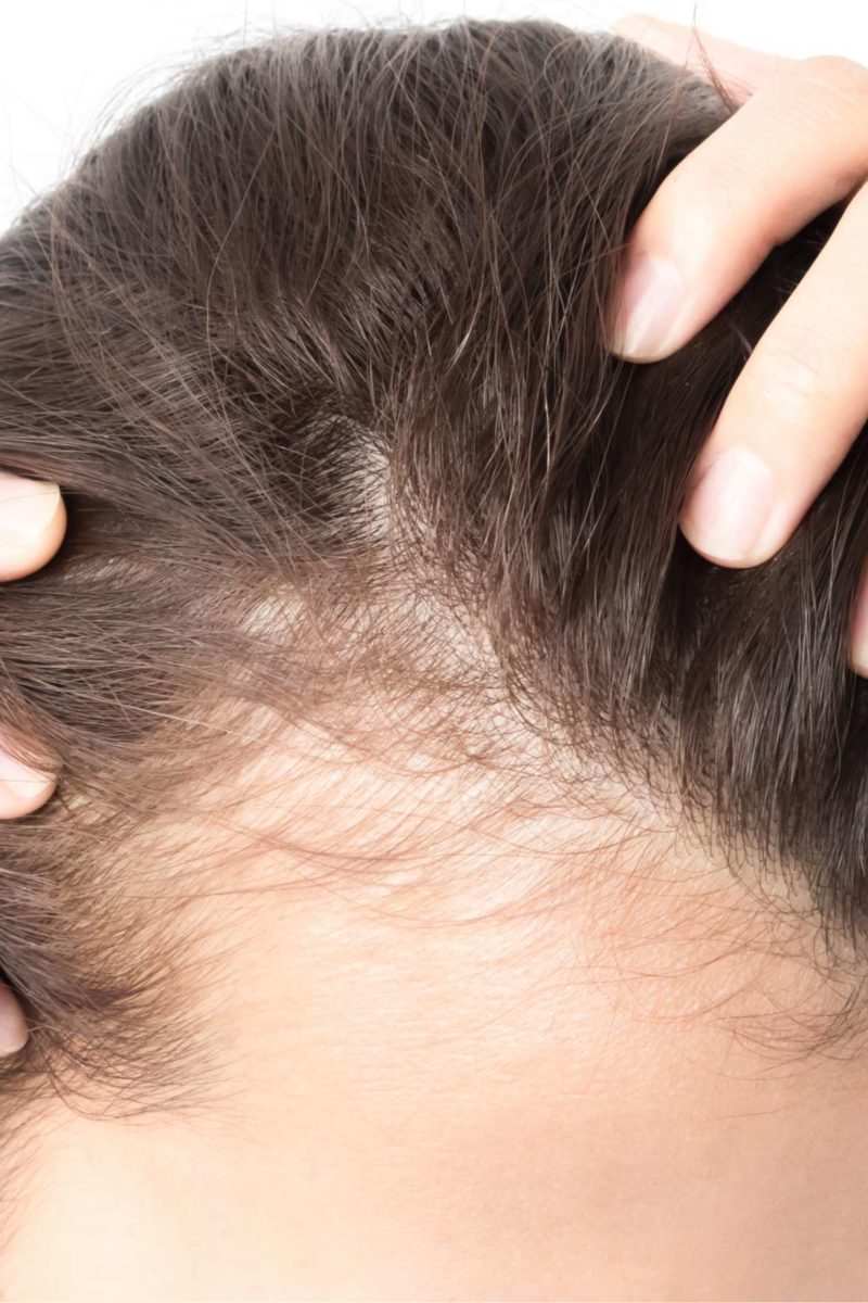 Hair loss (alopecia) - Myers Dermatology & Clinical Spa