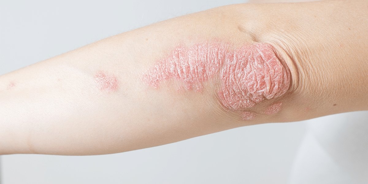 Psoriasis - Myers Dermatology & Clinical Spa