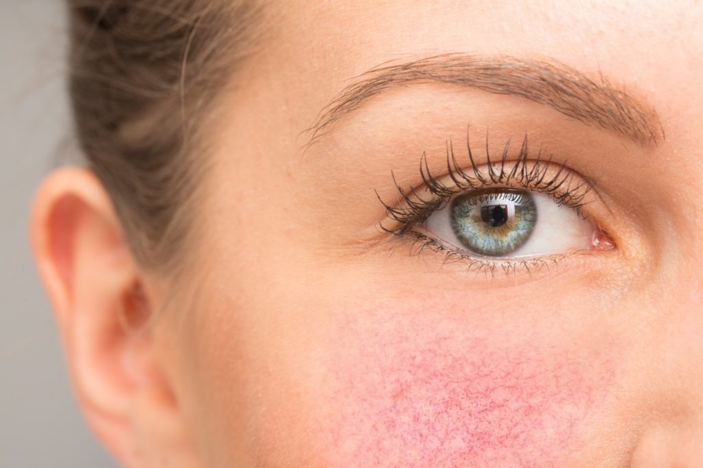 Rosacea - Myers Dermatology & Clinical Spa