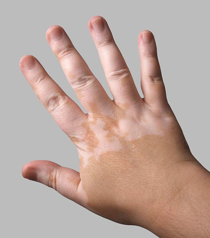Vitiligo - Myers Dermatology & Clinical Spa