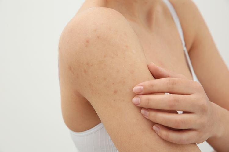 Bumpy skin | Myers Dermatology & Clinical Spa