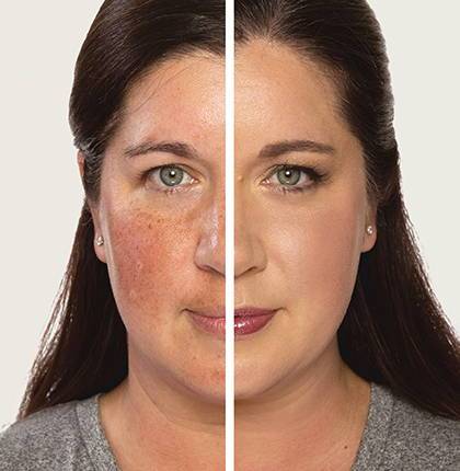 Rosacea / redness | Myers Dermatology & Clinical Spa