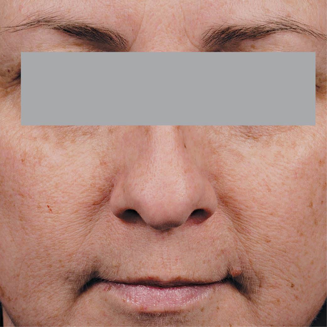 Phloretin CF Gel - Myers Dermatology & Clinical Spa