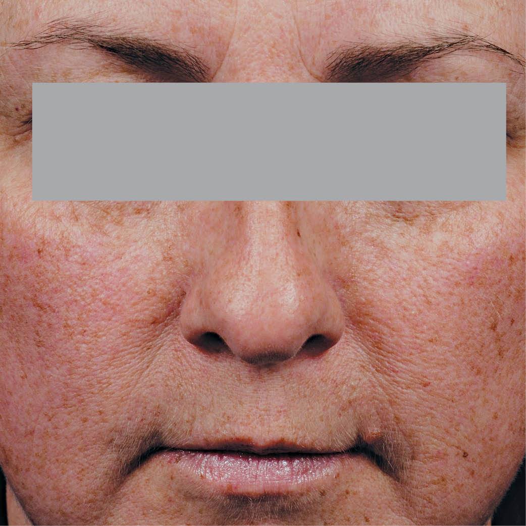 Phloretin CF Gel - Myers Dermatology & Clinical Spa