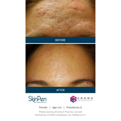 SkinPen Microneedling - Myers Dermatology & Clinical Spa