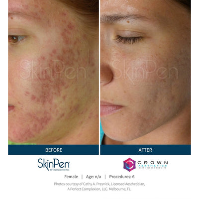 SkinPen Microneedling - Myers Dermatology & Clinical Spa